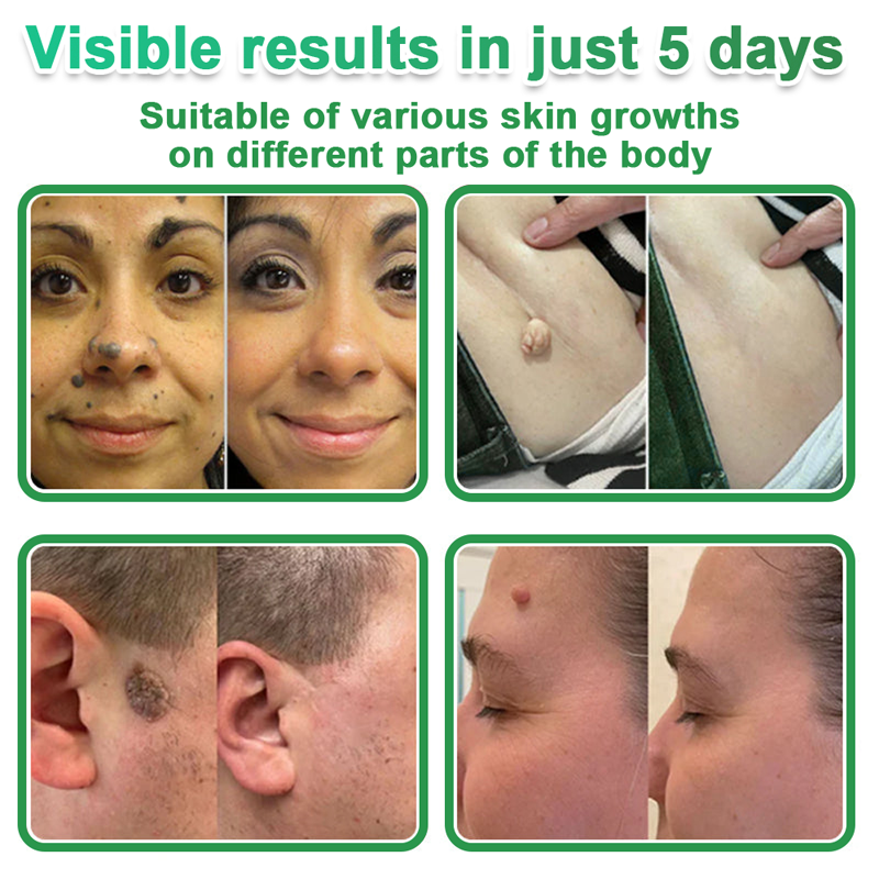 Hudros® 📌2-in-1 Microneedle & Hydrocolloid Pat🧪Raised Moles,Acne,  Flat Warts & Skin Tags Remover | Improves Wrinkles, Scars & Blemishes | Invisible Star Pimple Patches for Face & Body | 144 Count