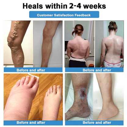 Healrize® 🗽4-in-1 Vein & Joint Nano Microneedle Advanced Therapy Patch🔥Instant Relief, Long-Term Results