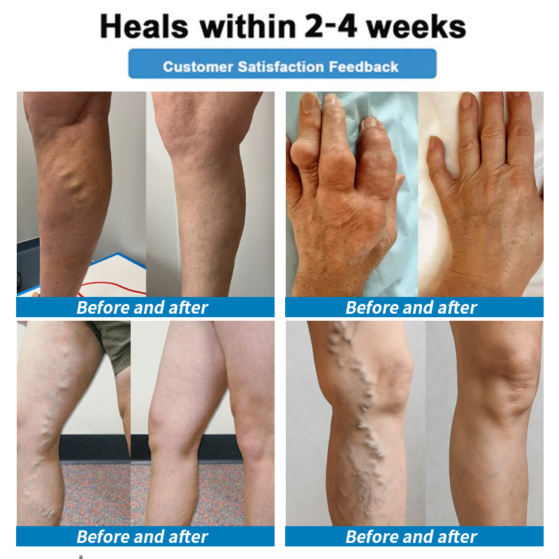 Healrize® 🗽4-in-1 Vein & Joint Nano Microneedle Advanced Therapy Patch🔥Instant Relief, Long-Term Results