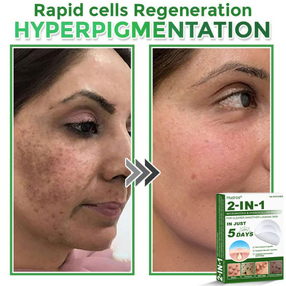 Hudros® 📌2-in-1 Microneedle & Hydrocolloid Pat🧪Raised Moles,Acne,  Flat Warts & Skin Tags Remover | Improves Wrinkles, Scars & Blemishes | Invisible Star Pimple Patches for Face & Body | 144 Count